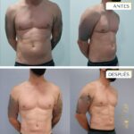 MarcacionAbdominal-drfelipeschmitt-banusclinic-marbella