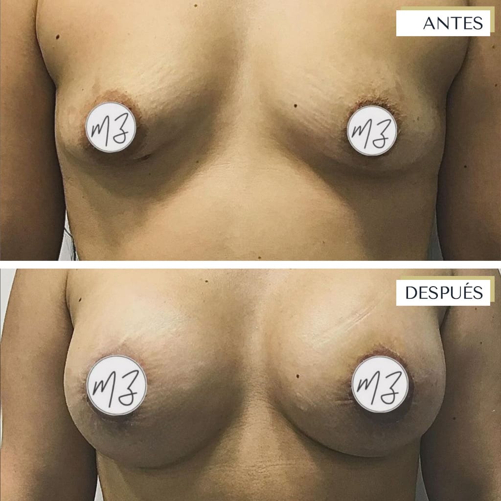 aumentodepecho-dramartazurita-banusclinic-marbella