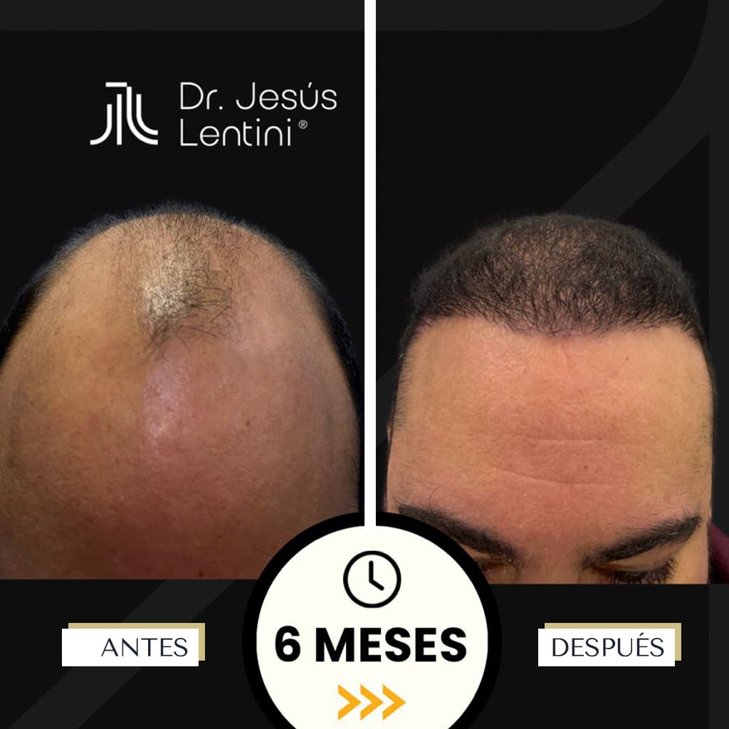 banusclinic-marbella-antes-despues-injertocapilar