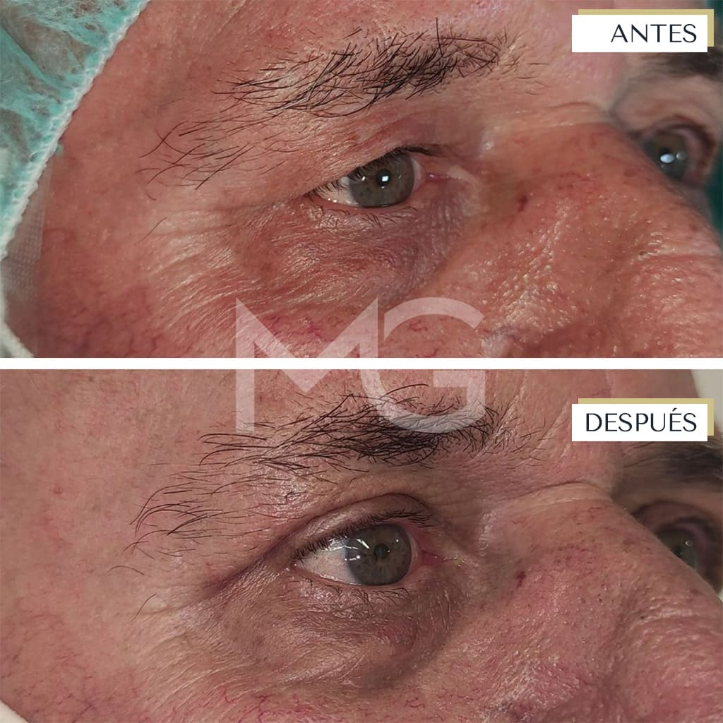 blefaroplastia-drmartinguerrero-banusclinic