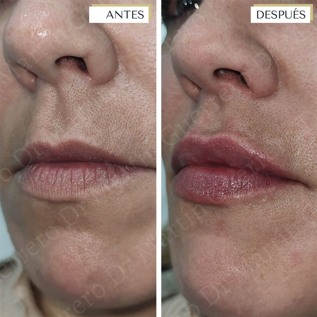 labios-drmartinguerrero-banusclinic-marbella